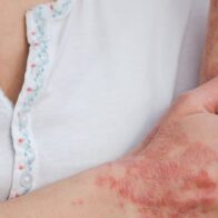 May 10: International Lupus Day | De Último Minuto English