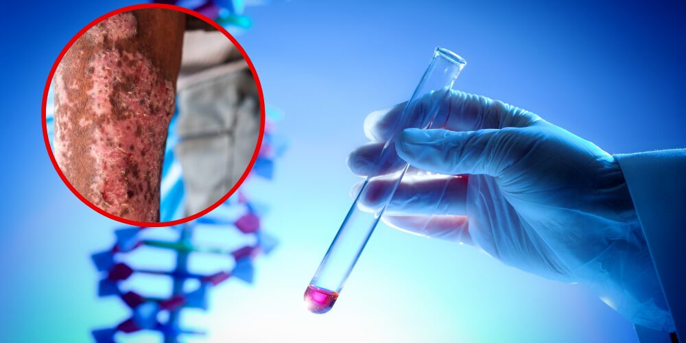 Analysis of ancient DNA reveals Europeans did not bring leprosy to America