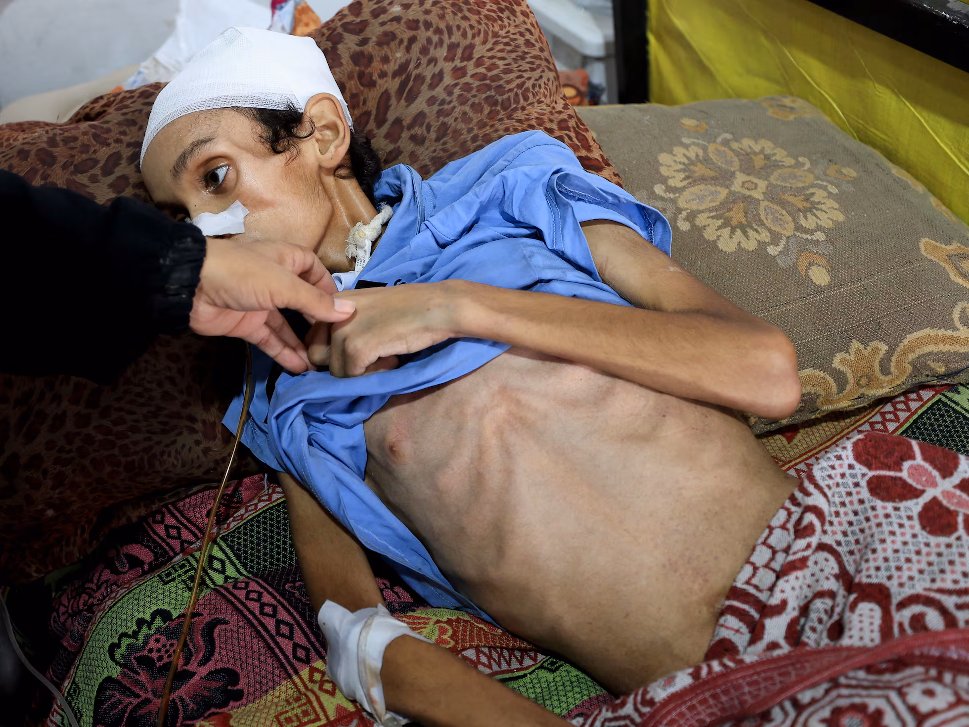 More Gazans have died from malnutrition in the first part of 2025 than in the previous two years | De Último Minuto English