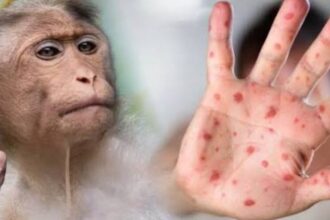 Costa Rica detects two cases of monkeypox and activates surveillance protocols | De Último Minuto English