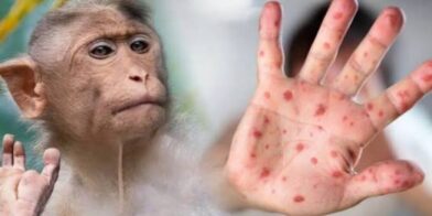 Costa Rica detects two cases of monkeypox and activates surveillance protocols | De Último Minuto English