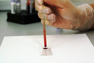 Study reveals blood test that improves detection of aggressive prostate cancer | De Último Minuto English