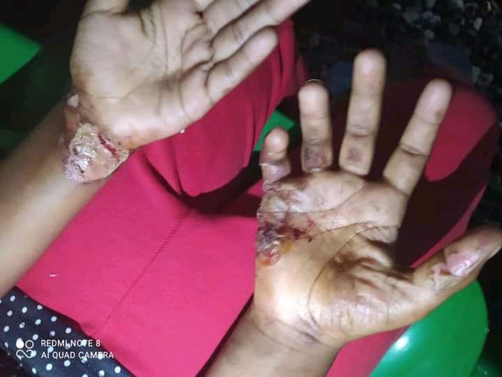 Mujer quema manitas a niña de ocho años porque le dejó caer un celular - Noticias de hoy en República Dominicana | De Último Minuto