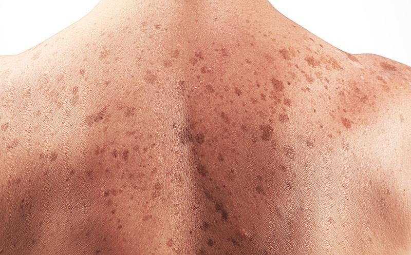 Día Mundial del Cáncer de Piel