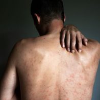 OMS: El 98% de casos de viruela del mono han sido detectados en homosexuales - Noticias de hoy en República Dominicana | De Último Minuto