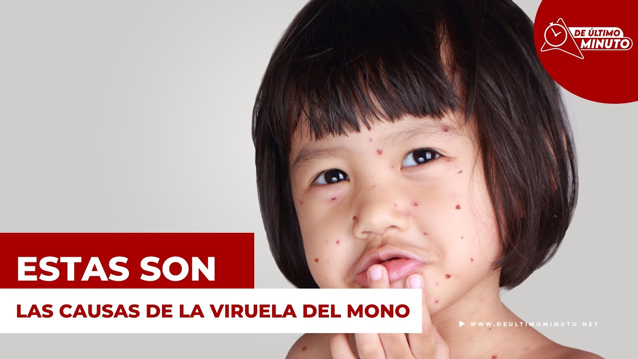 La Viruela del Mono está en RD: qué es, cómo prevenirla y la forma de tratar esta enfermedad - Noticias de hoy en República Dominicana | De Último Minuto