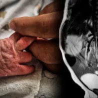 Operan con éxito en Guyana a un bebé que nació con una "cola humana" - Noticias de hoy en República Dominicana | De Último Minuto