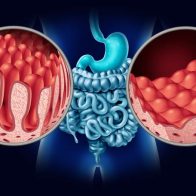 Enfermedad celíaca: cómo se diagnostica y cuáles son sus síntomas - Noticias de hoy en República Dominicana | De Último Minuto