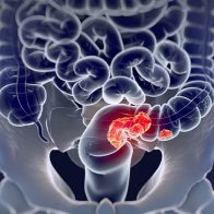 Peritonitis y Cáncer Colorrectal: Un duelo contra el tiempo