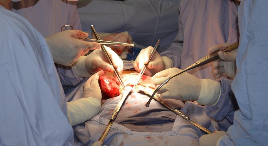 Una mujer en EEUU, segunda persona en el mundo que recibe un riñón procedente de un cerdo