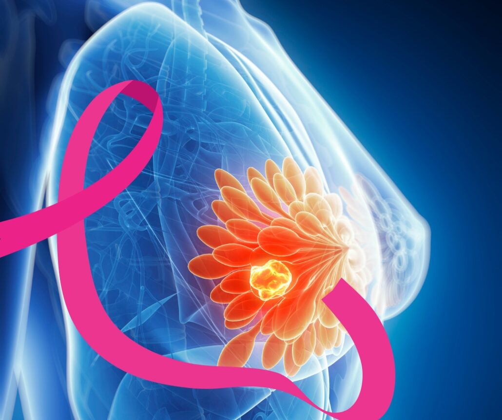 La inteligencia artificial, clave en la lucha contra el cáncer de mama en América Latina