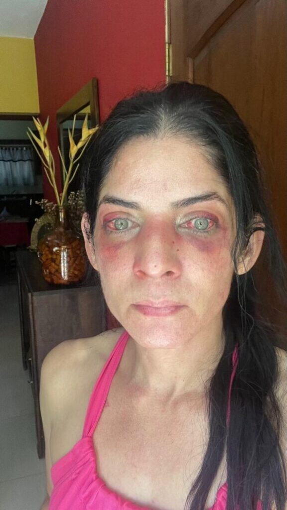 Mujer denuncia haber sido víctima de una brutal golpiza por su pareja en Jarabacoa | De Último Minuto