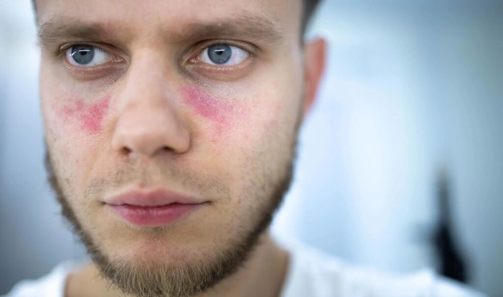 Día Mundial del Lupus: Visibilizando una enfermedad silenciosa y complicada | De Último Minuto
