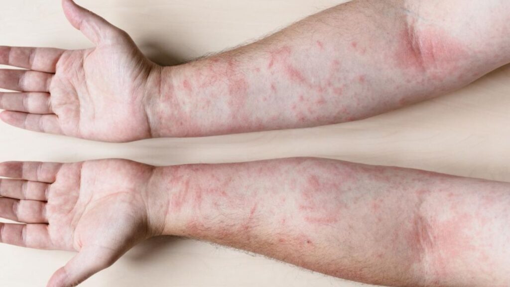 Día Mundial del Lupus: Visibilizando una enfermedad silenciosa y complicada | De Último Minuto