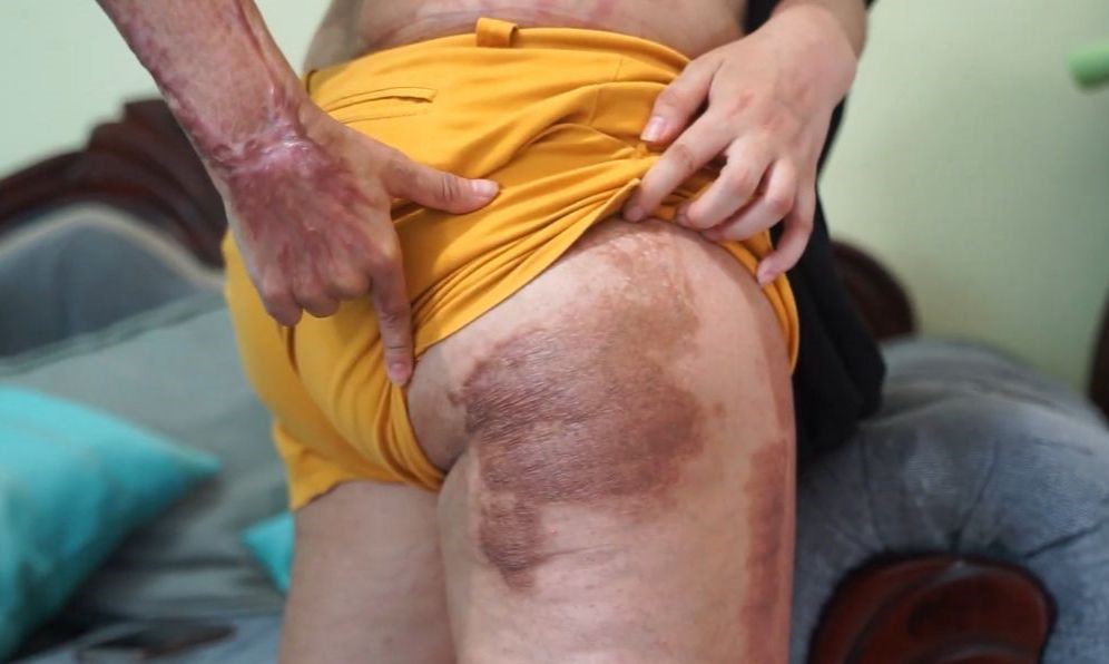 Nycole Gómez, una vida marcada por el fuego | 3 | Nycole Gómez, una vida marcada por el fuego - Noticias de hoy en República Dominicana | De Último Minuto