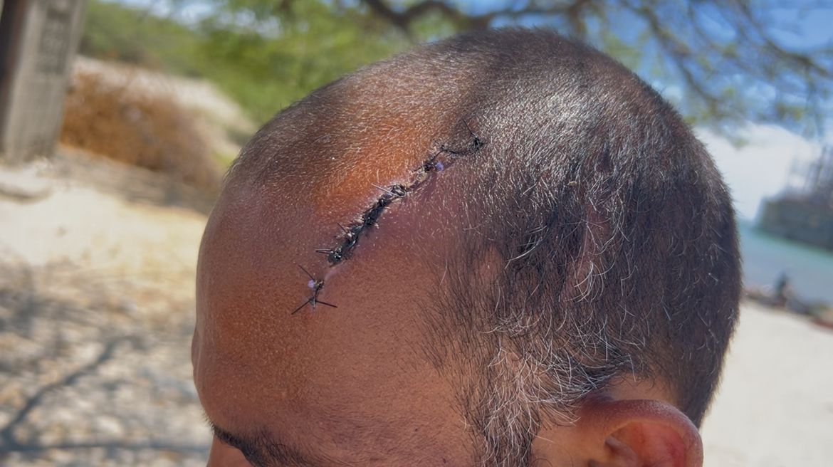 Hombre denuncia agresión a machetazos por parte de familiar de su ex pareja en Los Negros, Azua