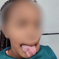 Madre pide ayuda para costear cirugía de su hija por malformación vascular que el seguro no cubre