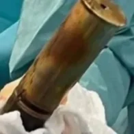 Extraen un obús de la Primera Guerra Mundial del recto de un joven en un hospital del sur de Francia