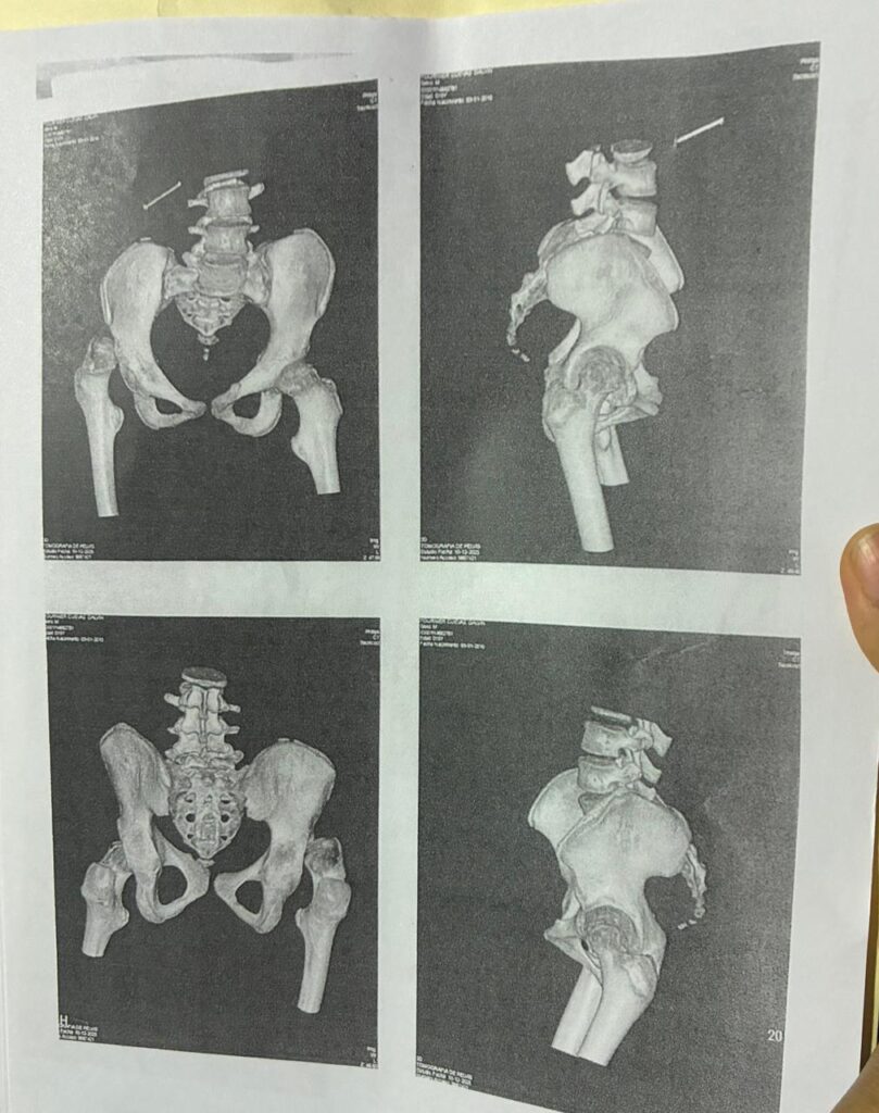 Madre solicita ayuda para costear cirugías de su hijo con parálisis cerebral | 2 | Madre solicita ayuda para costear cirugías de su hijo con parálisis cerebral - Noticias de hoy en República Dominicana | De Último Minuto