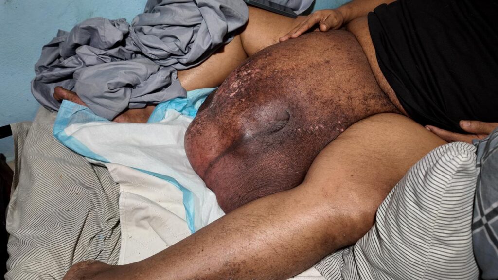 Joan Batista lucha contra tumor gigantesco que lo mantiene en cama; solicita ayuda para cirugía | 2 | Joan Batista lucha contra tumor gigantesco que lo mantiene en cama; solicita ayuda para cirugía - Noticias de hoy en República Dominicana | De Último Minuto