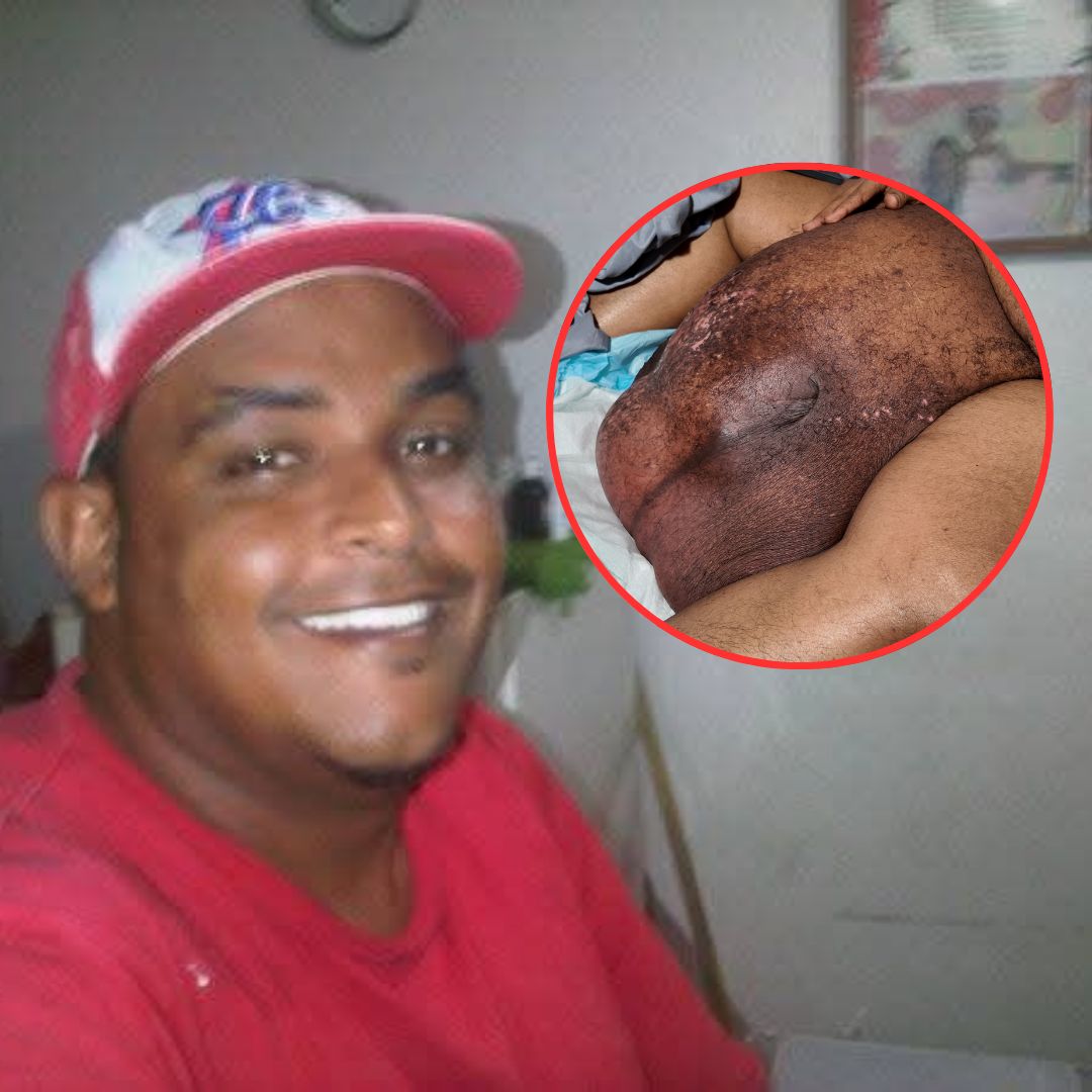 Tras reportaje de Bajo el Foco, ARS SeNaSa dará seguimiento al caso de Joan Batista Burgo - Noticias de hoy en República Dominicana | De Último Minuto