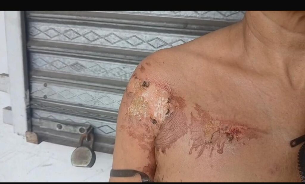 Mujer resulta con graves quemaduras tras ser atacada con aceite caliente por deuda de RD$1,000 en Moca | 2 | Mujer resulta con graves quemaduras tras ser atacada con aceite caliente por deuda de RD$1,000 en Moca - Noticias de hoy en República Dominicana | De Último Minuto