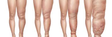 Día Internacional del Linfedema | 4 | Día Internacional del Linfedema - Noticias de hoy en República Dominicana | De Último Minuto