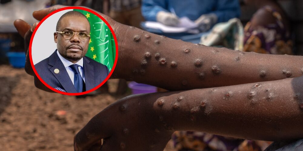 La República Democrática del Congo declara el fin de la viruela del mono