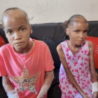 Dos hermanitas con “piel de mariposa” sobreviven en condiciones precarias y piden ayuda en SDE - Noticias de hoy en República Dominicana | De Último Minuto