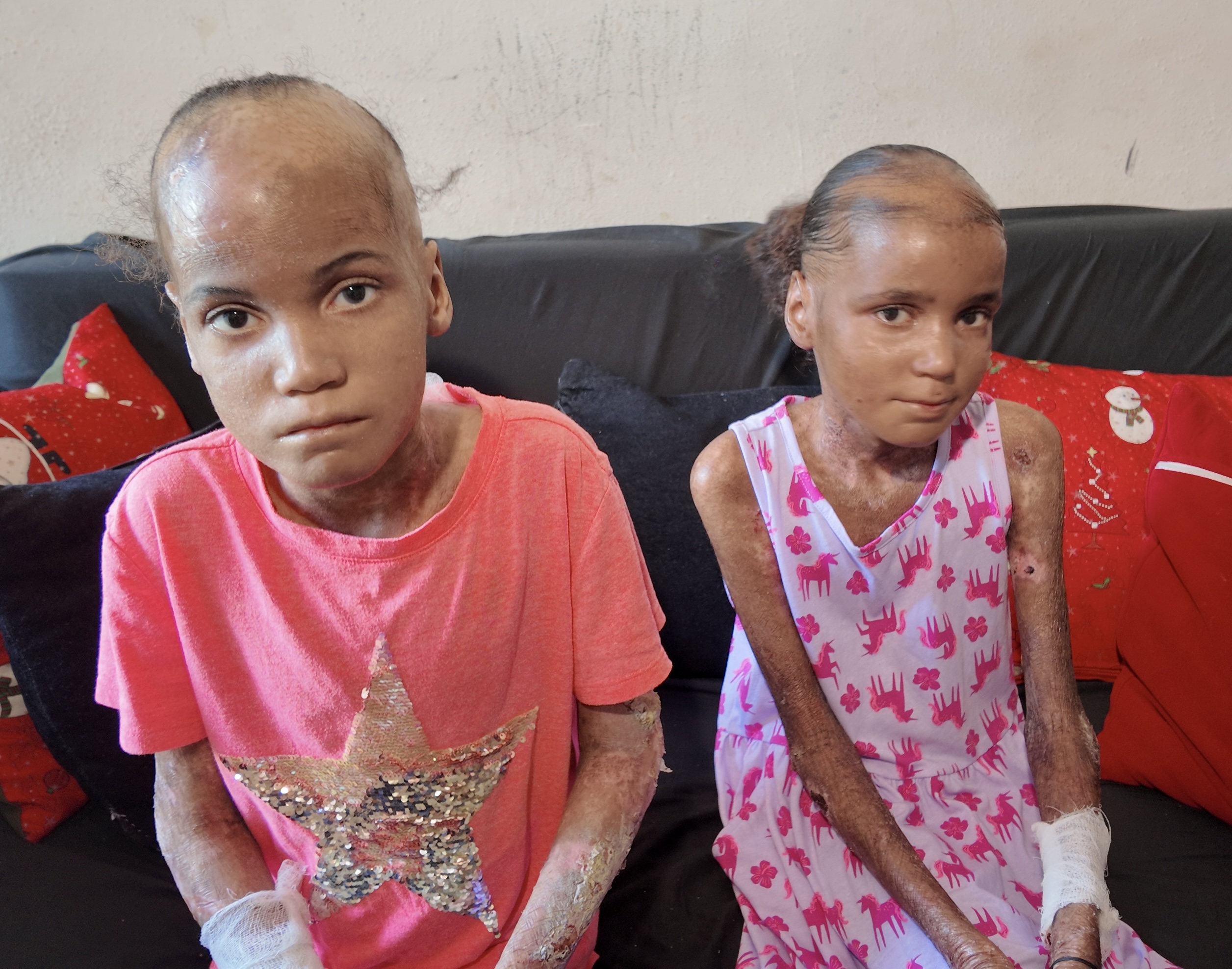 Dos hermanitas con “piel de mariposa” sobreviven en condiciones precarias y piden ayuda en SDE - Noticias de hoy en República Dominicana | De Último Minuto