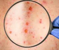 ¿Sarampión o varicela? Las claves para identificar sus síntomas ante el aumento de casos
