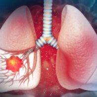 Humo que mata: 80% cáncer pulmón se asocia al tabaco - Noticias de hoy en República Dominicana | De Último Minuto