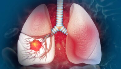 Humo que mata: 80% cáncer pulmón se asocia al tabaco - Noticias de hoy en República Dominicana | De Último Minuto