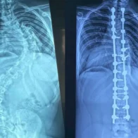Especialistas realizan 347 cirugías de escoliosis pediátrica en los últimos cuatro años