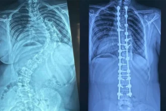 Especialistas realizan 347 cirugías de escoliosis pediátrica en los últimos cuatro años