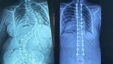 Especialistas realizan 347 cirugías de escoliosis pediátrica en los últimos cuatro años