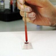 Estudio revela análisis de sangre que mejora la detección del cáncer de próstata agresivo