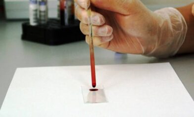 Estudio revela análisis de sangre que mejora la detección del cáncer de próstata agresivo